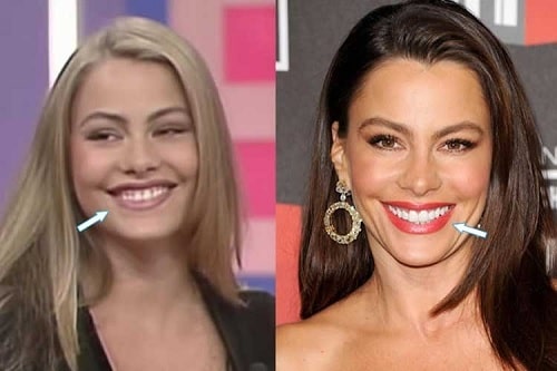 A picture of Sofia Vergara Before (left) and After (right).